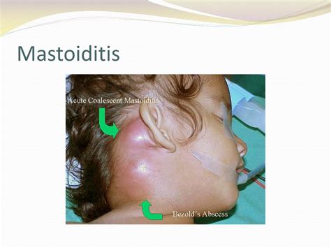 PPT - Otitis Media PowerPoint Presentation, free download - ID:5669922