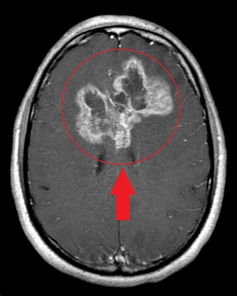 Astrocytoma MRI - wikidoc