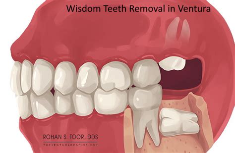 Abscessed Wisdom Tooth Extraction