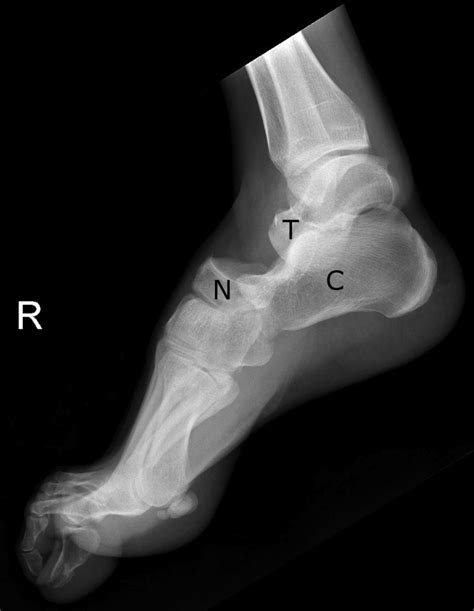 Subtalar dislocation - Radiology at St. Vincent's University Hospital