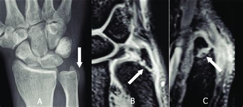 Non displaced fracture at the base of the styloid process of the ulna.... | Download Scientific ...