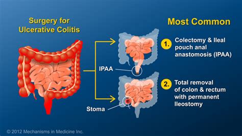 Slide Show - Small Bowel and Large Bowel Surgery for IBD