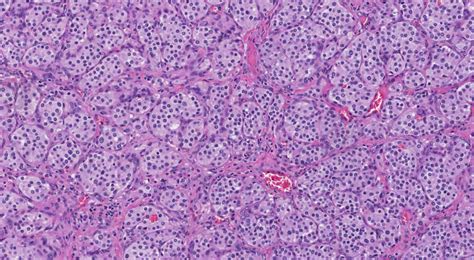 Paraganglioma | Atlas of Pathology