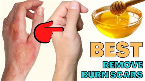 HOW TO REMOVE BURN SCARS FROM FACE & SKIN at home - Natural Scar Removal lotion/Salve - YouTube