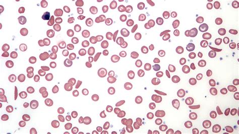 50 years ago, urea showed promise as a sickle-cell treatment