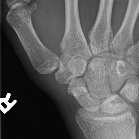 Scaphoid Bone Anatomy And Fractures Scaphoid Fracture Anatomy | My XXX Hot Girl