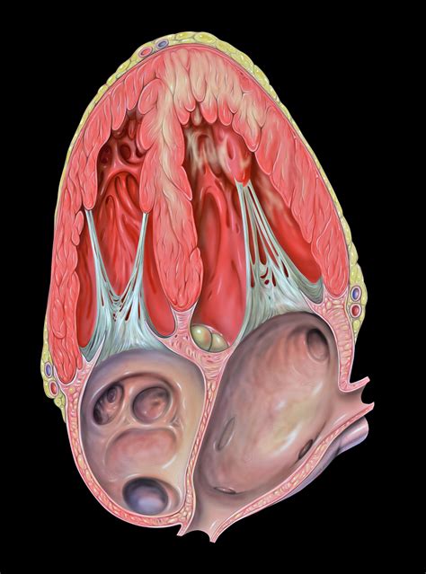 File:Heart ant wall dysf 4C.jpg - Wikimedia Commons