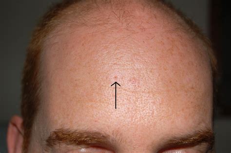 Dilated Pore of Winer – Perri Dermatology