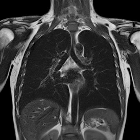 3 Tesla MRI Magnetic Resonance Imaging — North Country Neurology PC