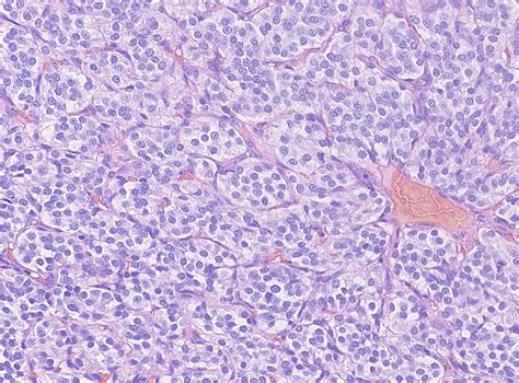 Pathology Outlines - Case of the Week #456