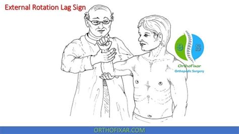 External Rotation Lag Sign | OrthoFixar 2024