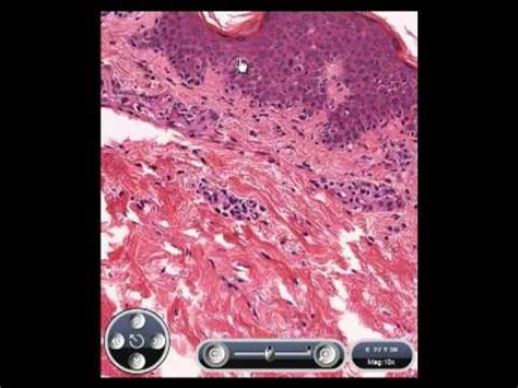 Discoid Lupus Erythematosus Histology