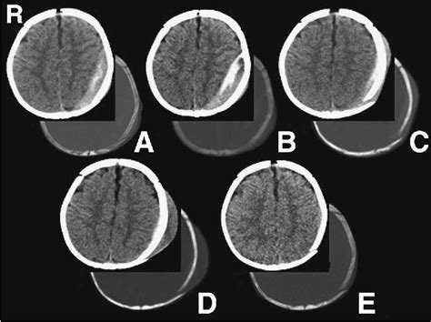 Figure 1 from Spontaneous slow drainage of epidural hematoma into the subgaleal space through a ...