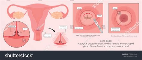 Cold Knife Cone Biopsy Loop Electrosurgical Stock Vector (Royalty Free) 1510916144 | Shutterstock