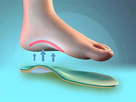 Choosing The Right Arch Support Insoles for Your Feet - CloudMineInc