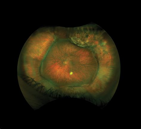 Myopic Refraction With Scleral Buckle - Modern Optometry