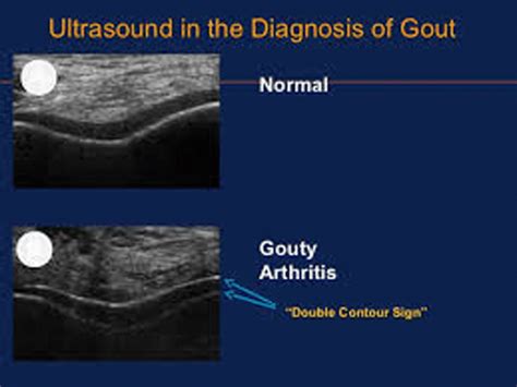 Schematic of ultrasound in the diagnosis of GOUT | Download Scientific ...