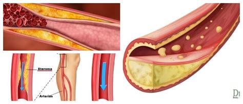 Ateroma: Causas, Síntomas, Efectos, Complicaciones y Prevención ...