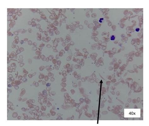 Sickle Cell Anemia Blood Smear Diagram | Quizlet