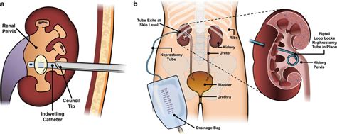 Pin on kidney stones