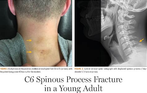 C6 Spinous Process Fracture in a Young Adult. | Semantic Scholar