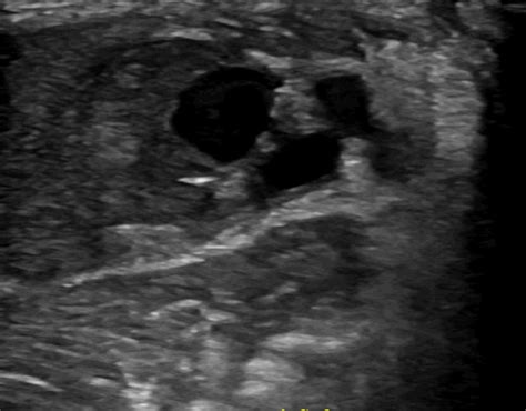 Pseudoaneurysm - Critical Care Sonography