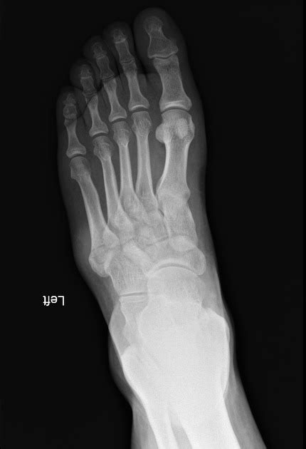 Pseudo Jones Fracture