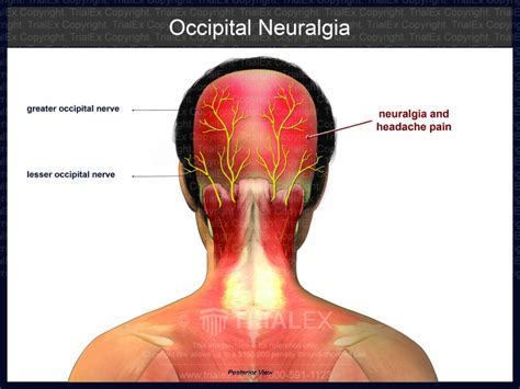 Occipital Neuralgia - TrialQuest Inc.