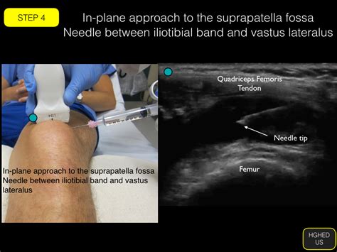 Arthrocentesis: Knee — Highland EM Ultrasound Fueled pain management