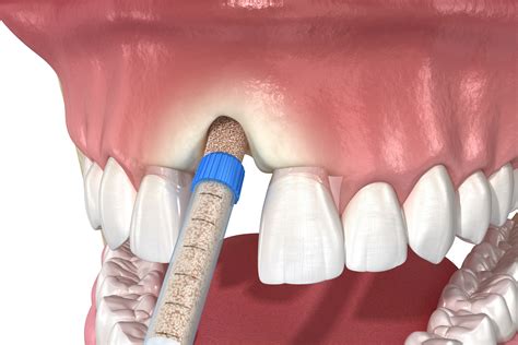 What Is Dental Bone Grafting & What To Expect