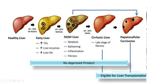 Fisiopatologia Digestiva Lesion Hepatica Youtube – Otosection