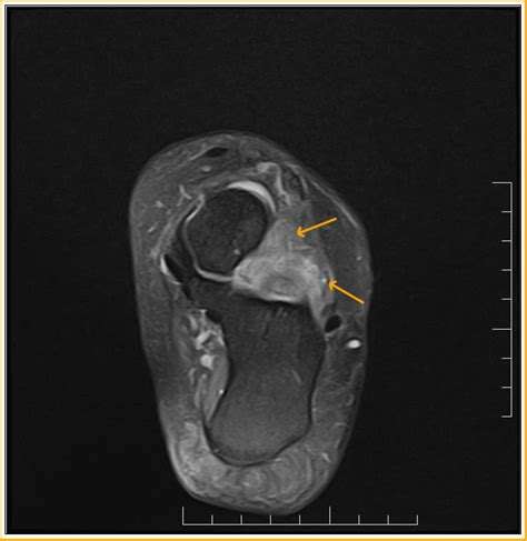 Sinus Tarsi Syndrome : MRI - Sumer's Radiology Blog