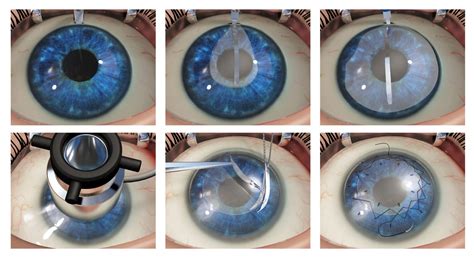 Deep anterior lamellar keratoplasty (DALK) - Niios