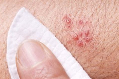 Why is Shingles on the Increase? | Healing Natural Oils