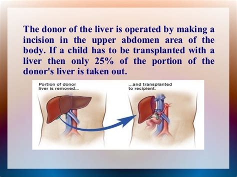 Procedures For Successfully Carrying Out A Liver Transplant