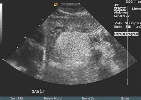 Angiomyolipoma ultrasound - wikidoc