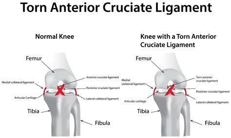 Acl Tear Football