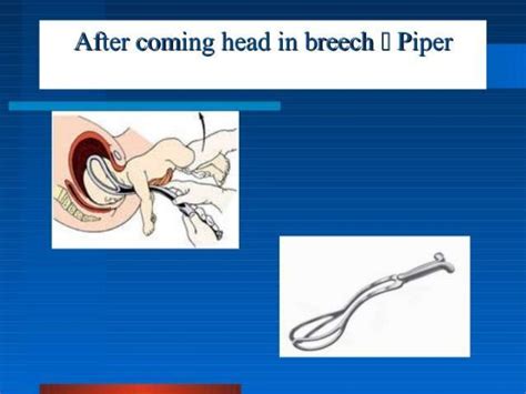 Forcep delivery