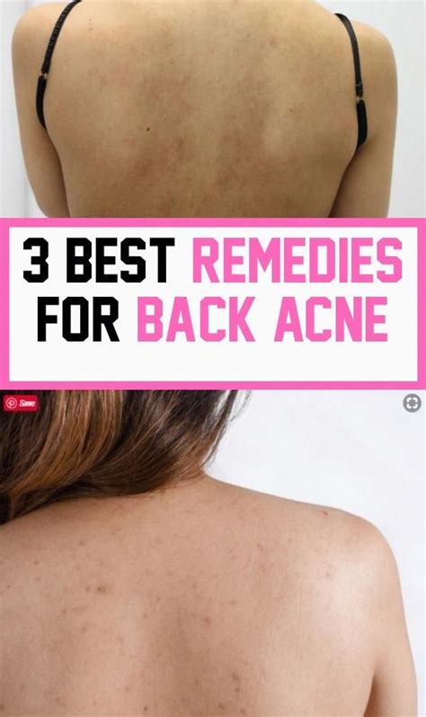 3 Best Remedies For Back Acne in 2020 | Back acne remedies, Best acne remedies, Acne remedies