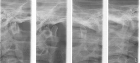 TMJ Assessment: Jaw Range of Motion, Noise, and Tenderness