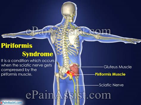 Piriformis Syndrome: Treatment, PT, Exercise, Prevention