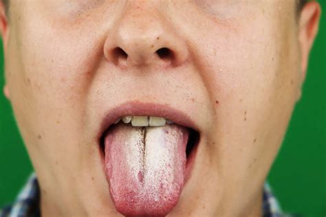 Lengua agrietada o fisurada: causas y tratamiento - Mejor con Salud