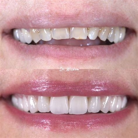 eMax Veneers in Montreal | What is eMax | eMax Veneers Cost