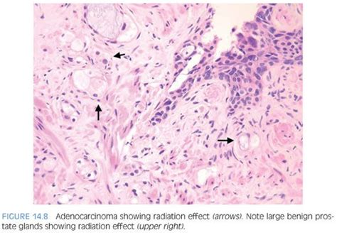 Benign and Malignant Prostate following Treatment | Basicmedical Key