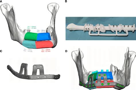 Frontiers | Mandibular Reconstruction With Fibula Flap and Dental Implants Through Virtual ...