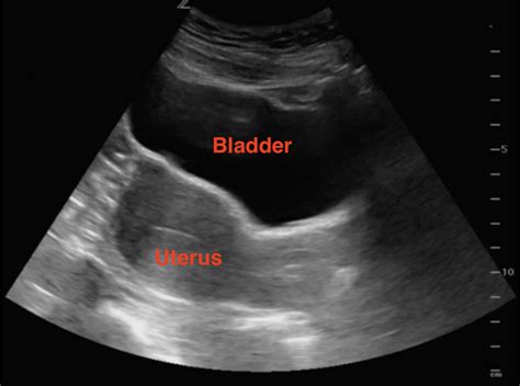 Sonoguide // Early Pregnancy