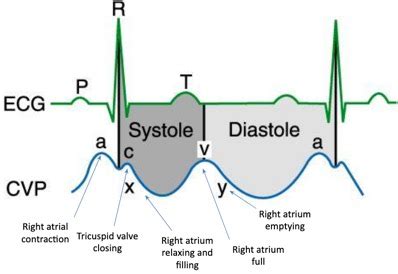 Online Central Venous Pressure (CVP) Course | IvyLeagueNurse