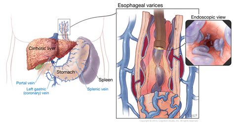 Esophageal Varices Nursing Management - RNpedia