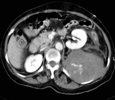 CT scan demonstrates left retroperitoneal hematoma with | Open-i