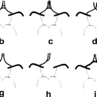 Anatomic variations of the anterior part of the circle of Willis ...